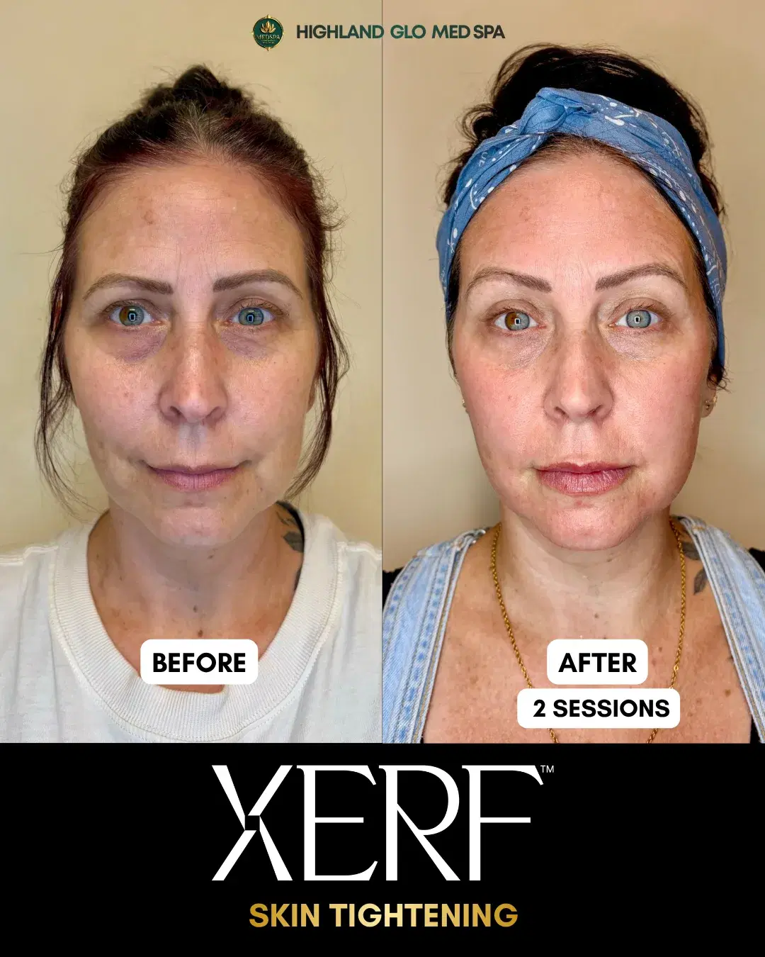 Before and after skin tightening with XERF at Highland Glo Med Spa