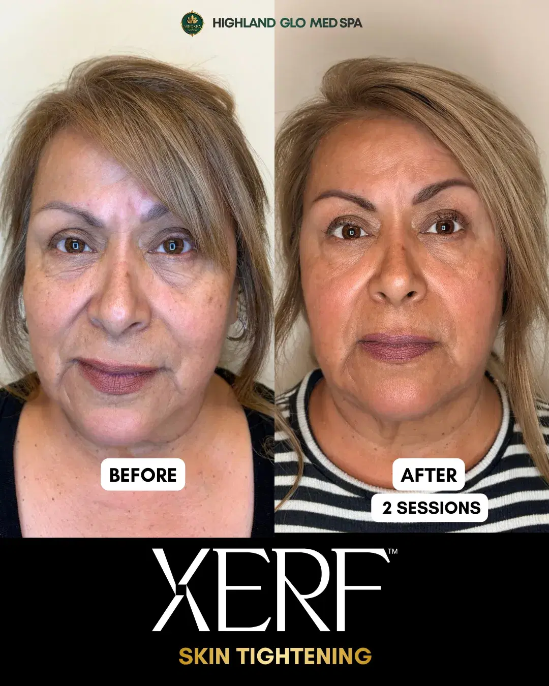 Before and after skin tightening with XERF at Highland Glo Med Spa